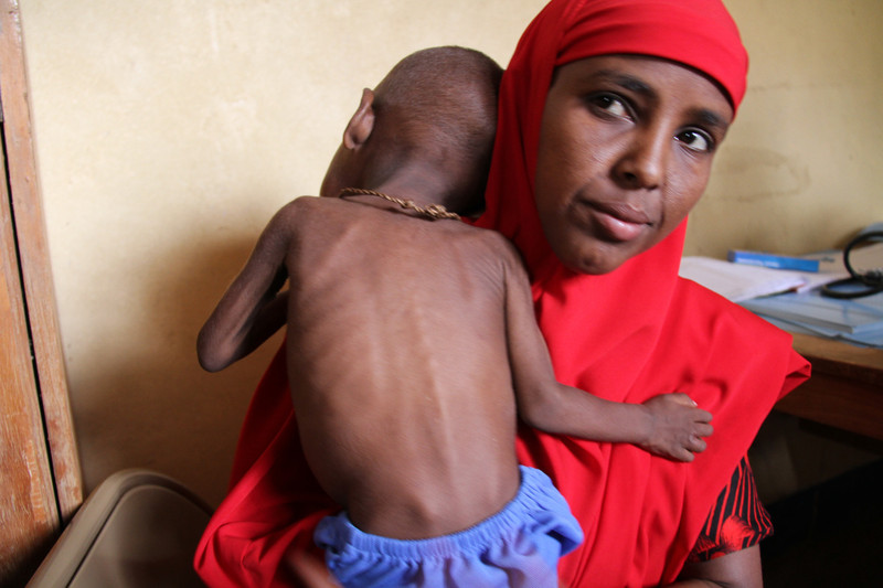 Somalia. Sangaboo fa visitare il figlio di 13 mesi, gravemente malnutrito, al centro di salute del campo di Dollo. Credits: JenniferOGorman/Oxfam Somalia. Sangaboo fa visitare il figlio di 13 mesi, gravemente malnutrito, al centro di salute del campo di Dollo. Credits: JenniferOGorman/Oxfam