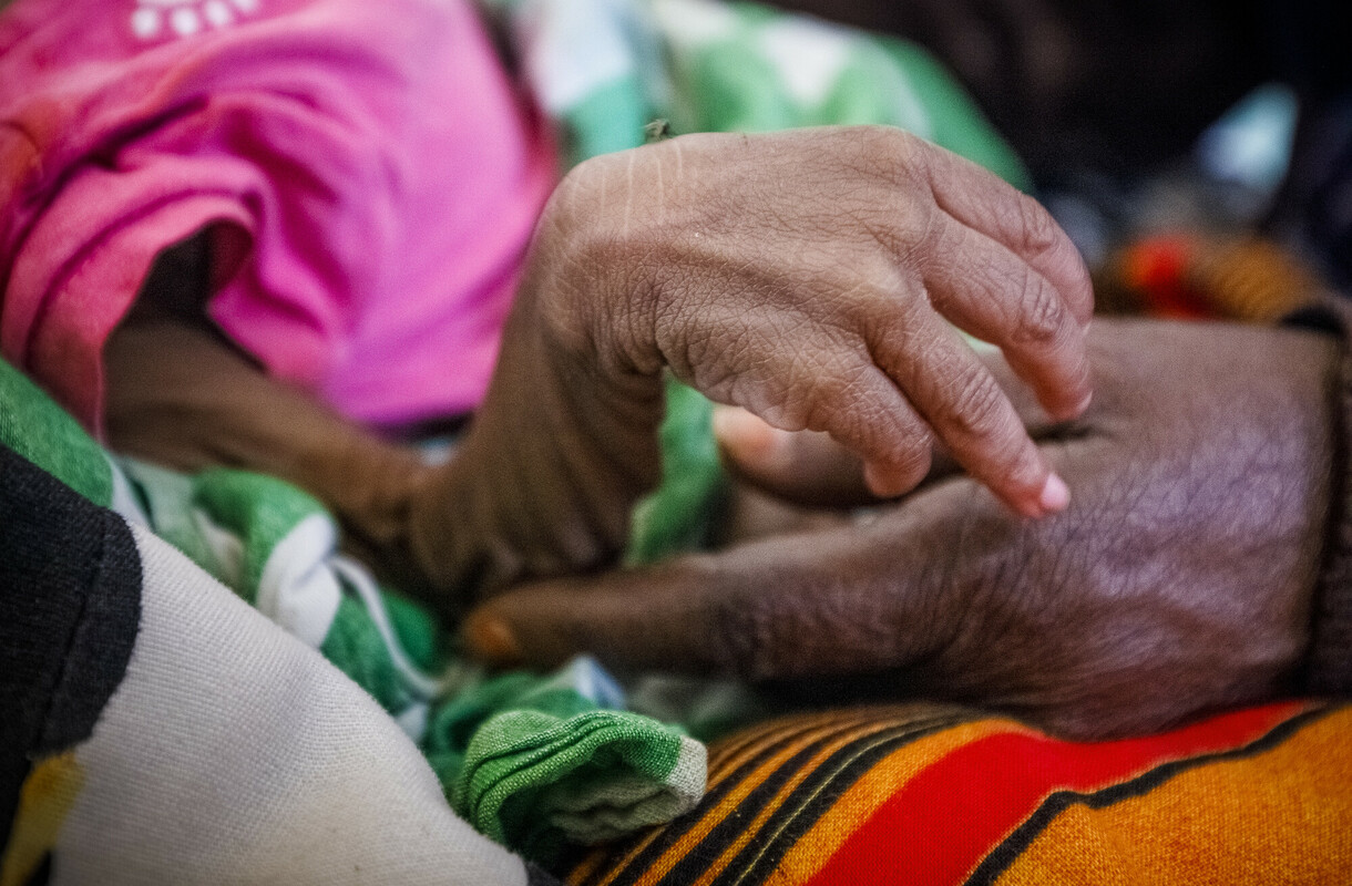 Somalia. La mano di Magda, una bambina gravemente denutrita, ricoverata in un centro di salute. Foto: Petterik Wiggers/Oxfam